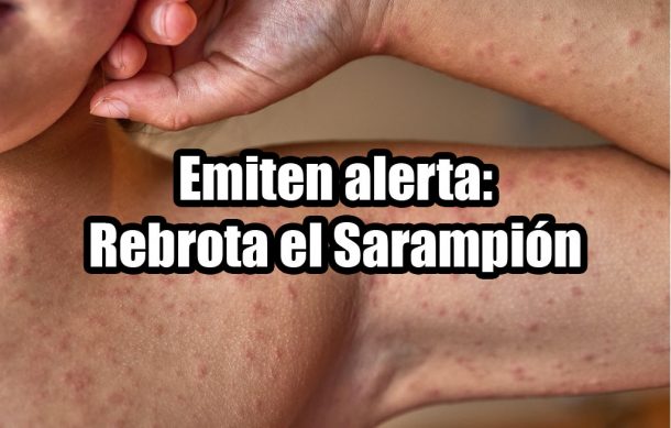 Emiten alerta: Rebrota el Sarampión