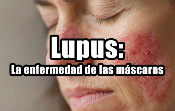 Lupus: La enfermedad de las máscaras