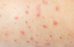 El menor de cuatro años que murió de sarampión no tenía ninguna vacuna: Pérez Gómez