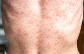 Jalisco rebasa los 400 casos de sarampión; reporta 28 en las últimas horas