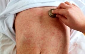 Confirman primera muerte por sarampión de 2026 en Jalisco