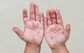 Se aplana la curva epidemiológica de sarampión en Jalisco