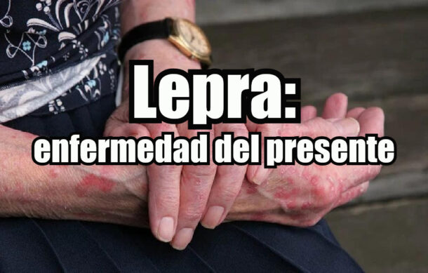 Lepra: enfermedad del presente