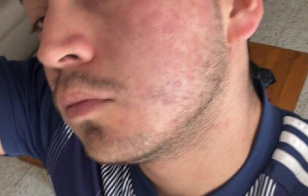 Reportan caso grave de dermatitis por el agua del SIAPA