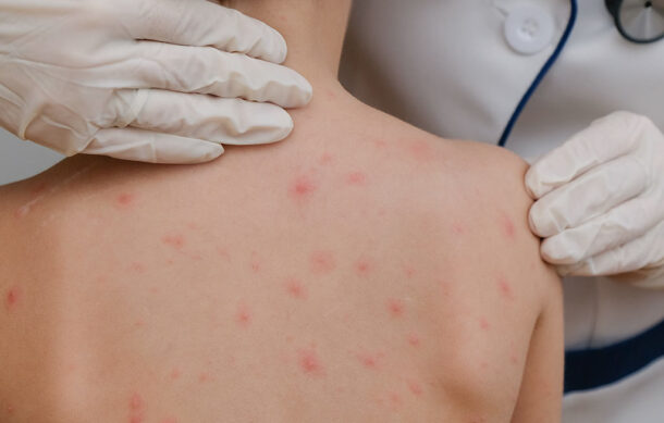 Sarampión a la baja en Jalisco: SSJ