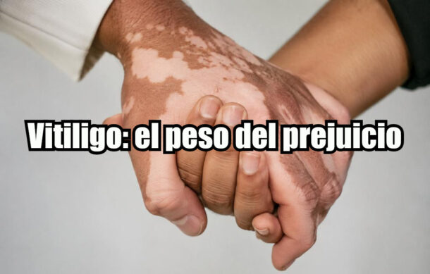 Vitiligo: el peso del prejuicio